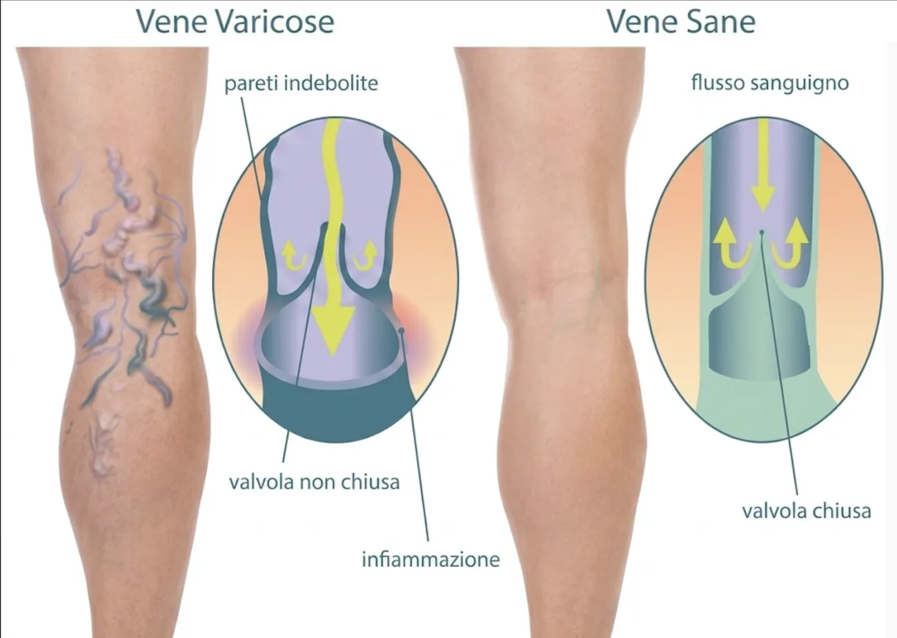 Vene varicose vs vene sane — meccanismo della T.R.A.P.